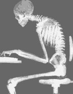Xray image of man at computer with very curved spine