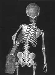 An x-ray picture of a child carrying a school bag clearly shows misalignment of the spine